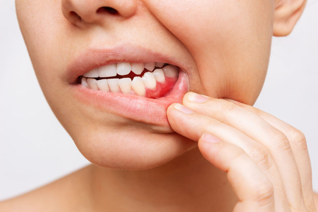 scaling and root planing gum disease in Wichita, KS