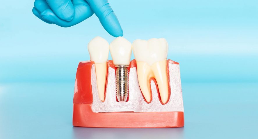 Missing Teeth Consider Dental Implants Cambridge Family Dentistry Wichita Ks