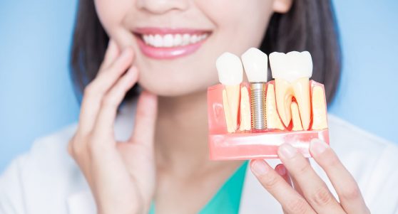 Dental Implant in Wichita