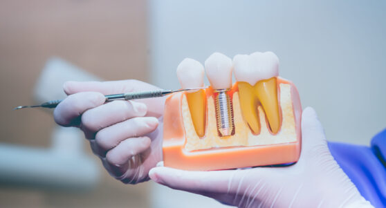 Dental Implants in Wichita