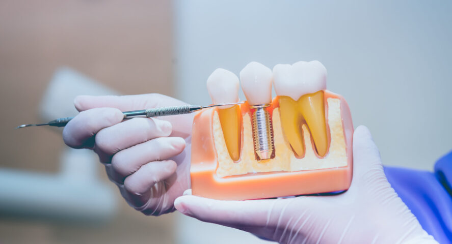 Dental Implants in Wichita