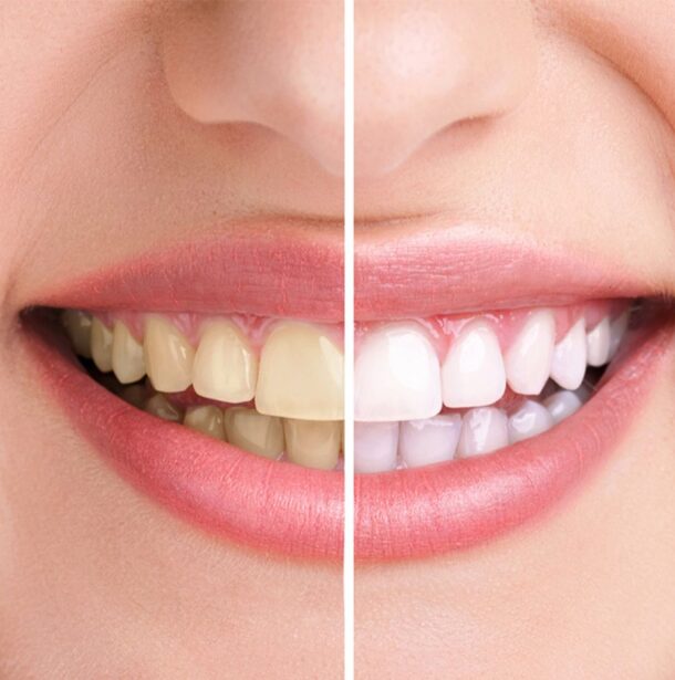 Teeth Whitening cosmetic dentist