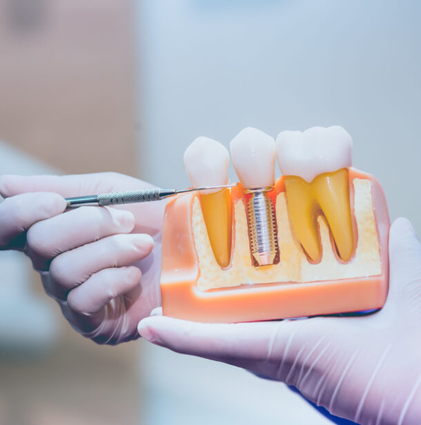 dental implants Wichita dentist