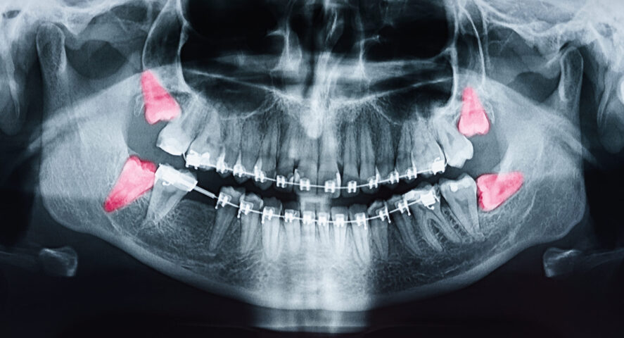 tooth extractions in Wichita
