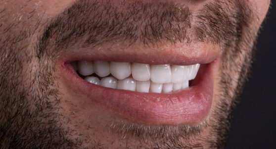 cosmetic treatment for a chipped tooth dental bonding in Wichita