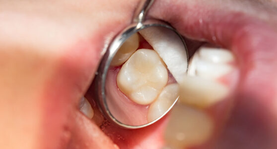 Dental Fillings in Wichita