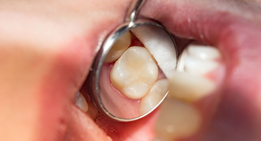 Dental Fillings in Wichita