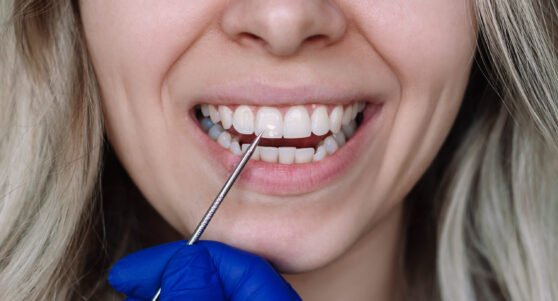 dental bonding Cosmetic Dentistry in Wichita