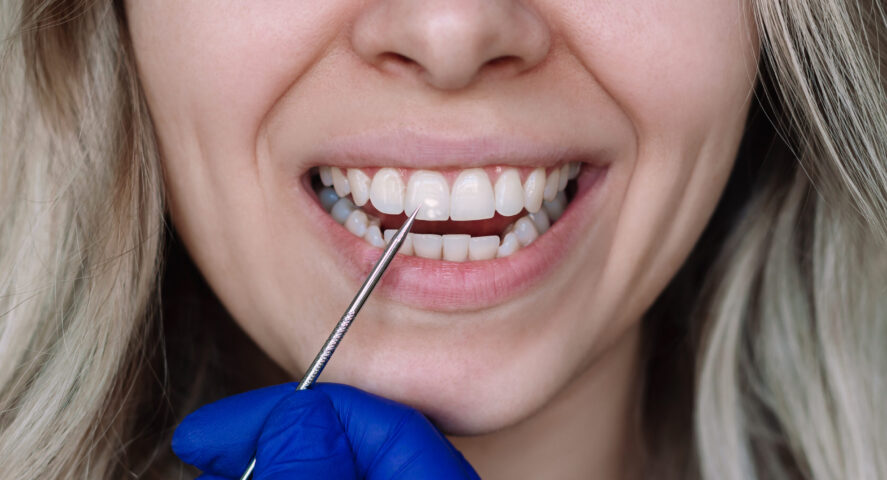 dental bonding Cosmetic Dentistry in Wichita